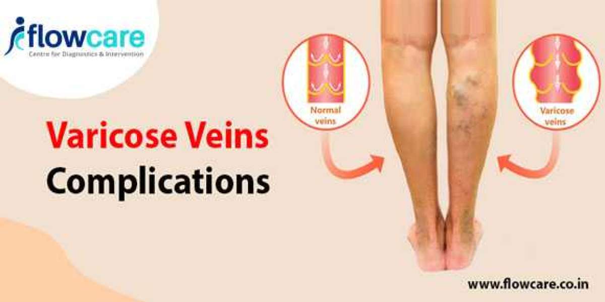 Varicose Veins Complications