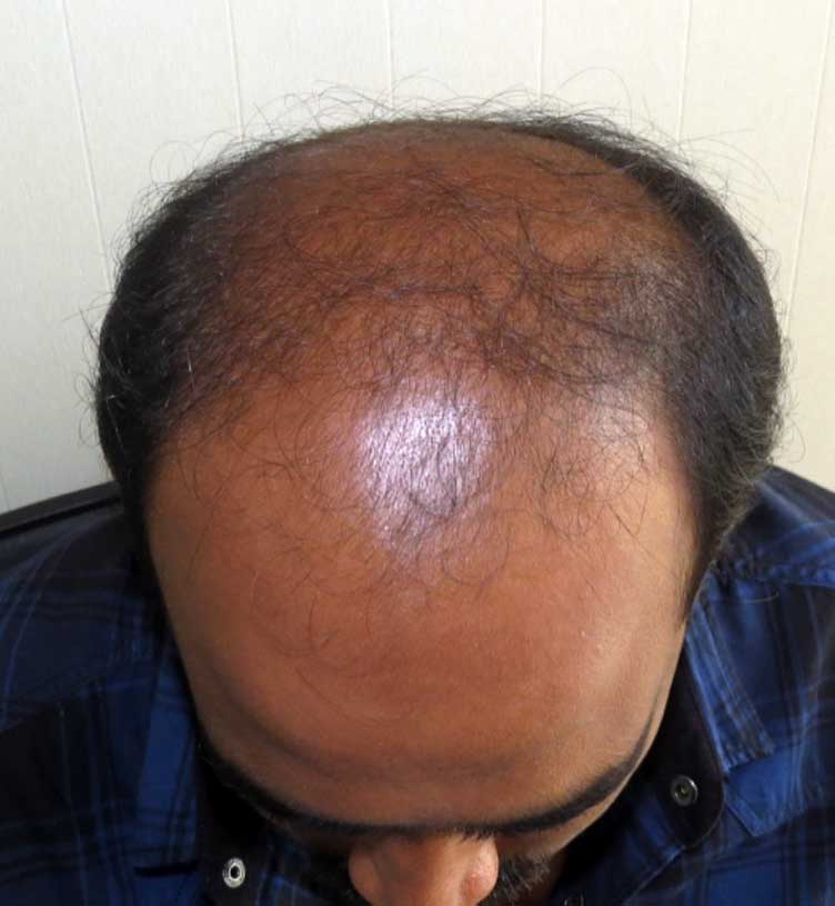 Hair Loss Causes – Neo Follicle Transplant – Hair Transplant Clinic
