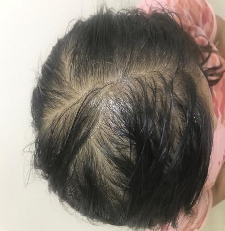 Pregnancy Hair Loss (POS-PARTUM ALOPECIA) – Neo Follicle Transplant – Hair Loss Treatment Clinic
