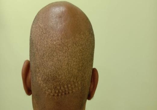 Difficult Situations in FUE – Neo Follicle Transplant – Hair Clinic