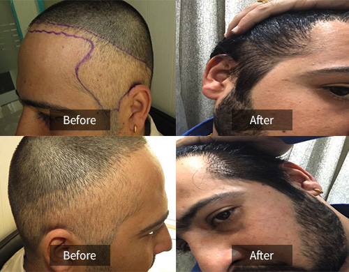 HAIR TRANSPLANT IN TRACTIONAL ALOPECIA