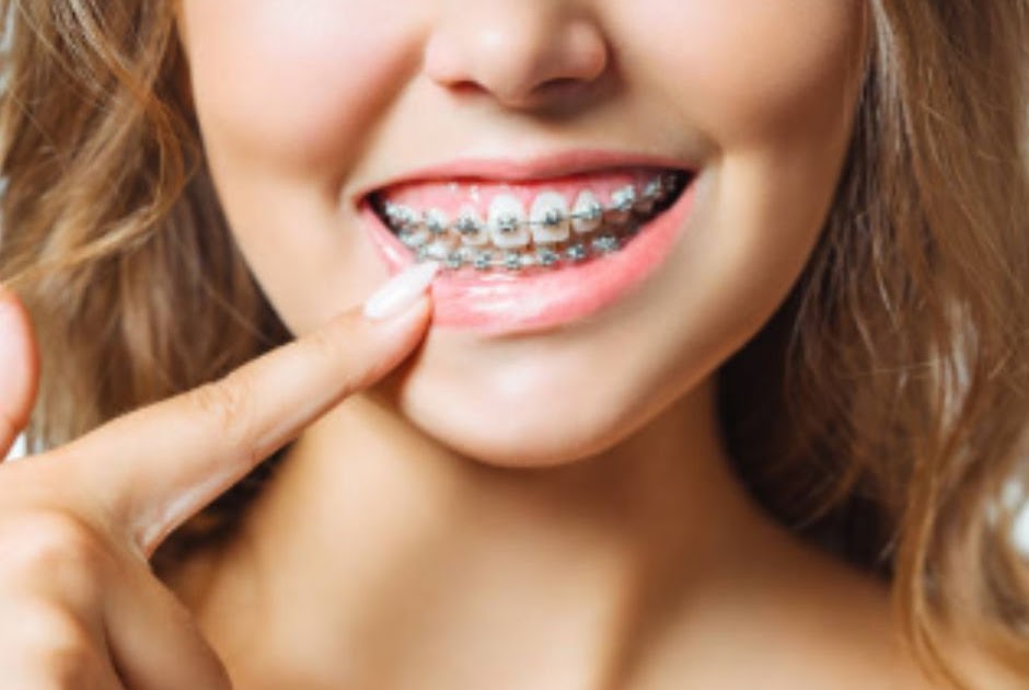 An Insight On Braces In Need And its Cost