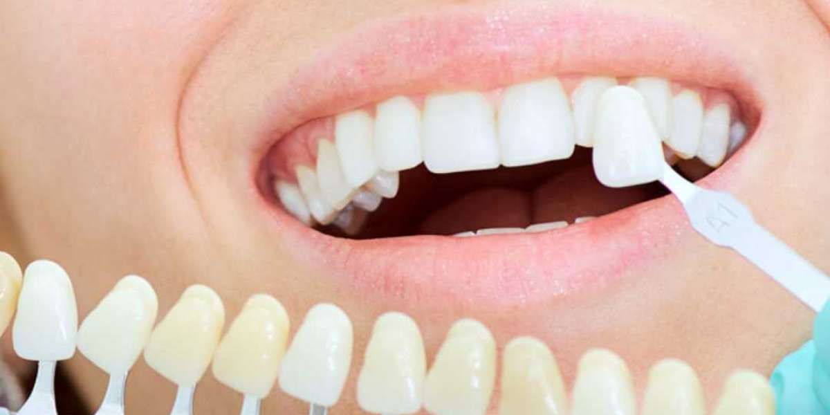 Discover Smiling Confidence with Dentures Near Me in Charleston!