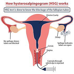 Hysterosalpingogram (HSG) Test for Blocked Fallopian Tubes -