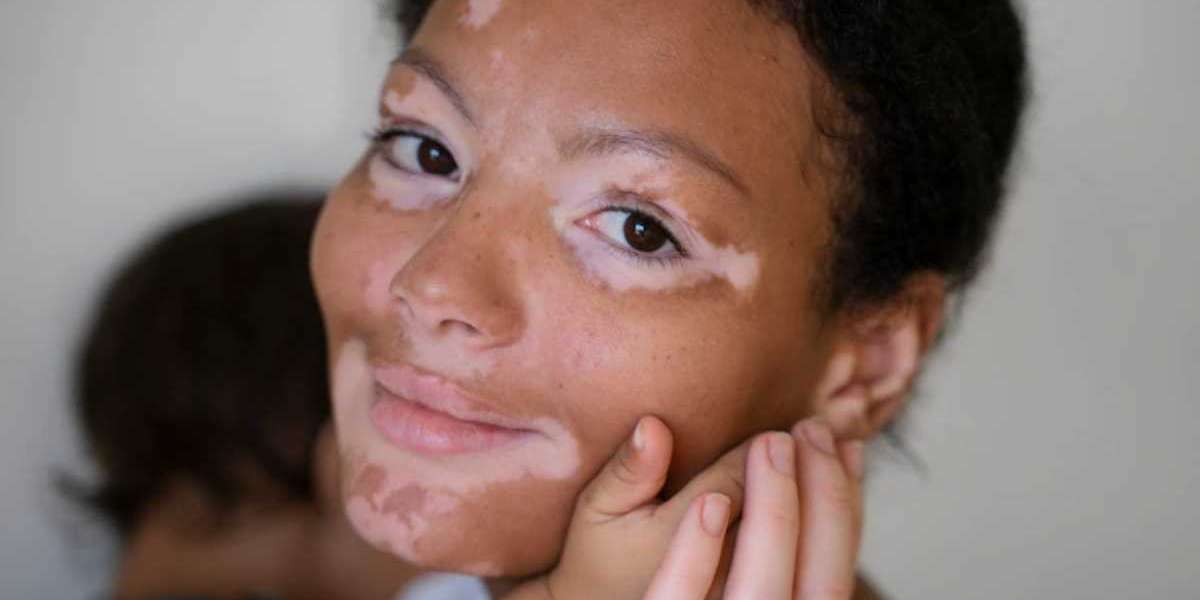 What is Stem Cell Therapy Can Vitiligo be Treated with Stem Cell Therapy?