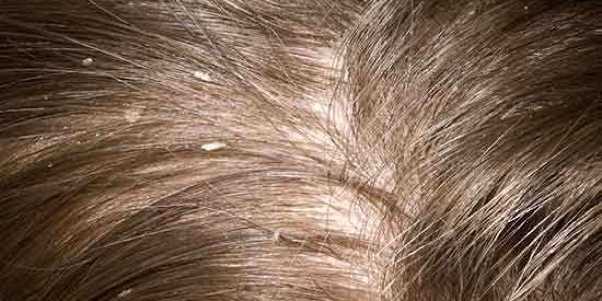 Dandruff in Children: Symptoms, Causes, How to Treat and Prevent It Safely