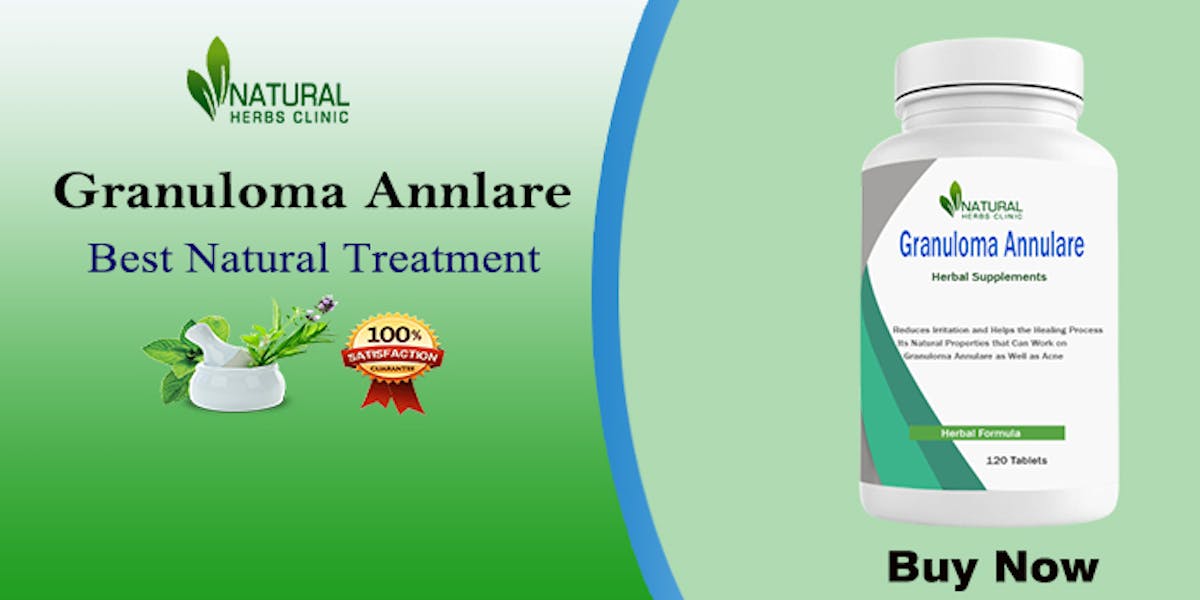 How to Use Natural Cures for Granuloma Annulare Relief