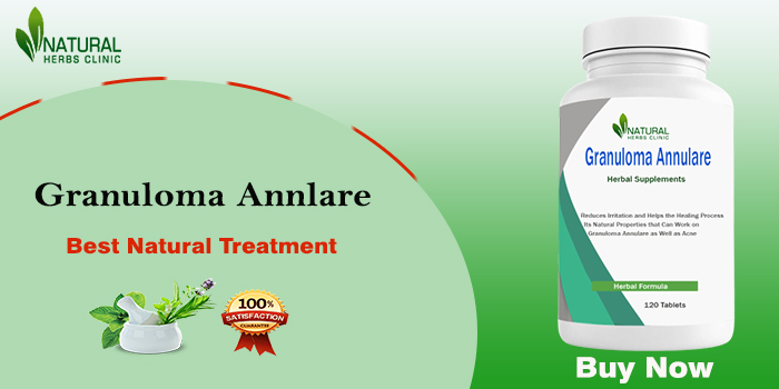 Buy Granuloma Natural Remedies to Cure it Completely