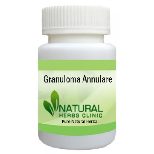 Herbal Treatment for Granuloma Annulare | Natural Remedies | Natural Herbs Clinic
