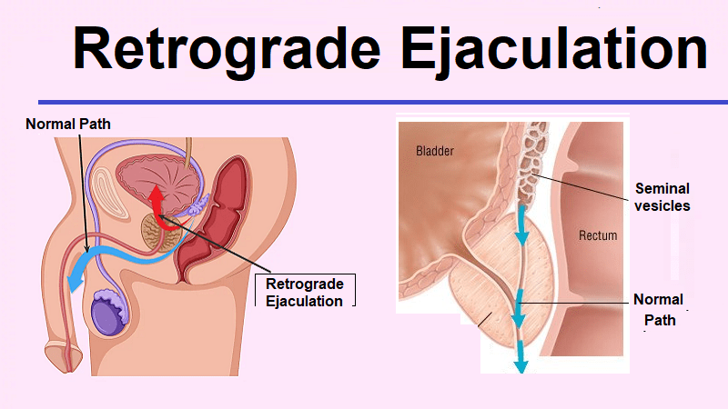 What are the Causes of Foamy Urine in Men?