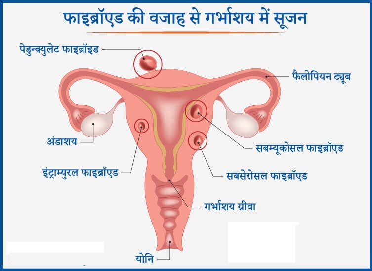 Bulky Uterus in Hindi -बच्चेदानी में सूजन क्या है?