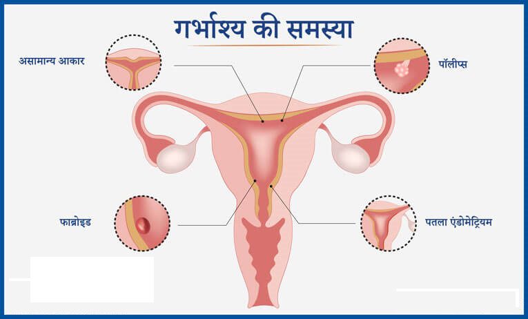 Uterus Problem in Hindi-जाने गर्भाशय की समस्या के लक्षण
