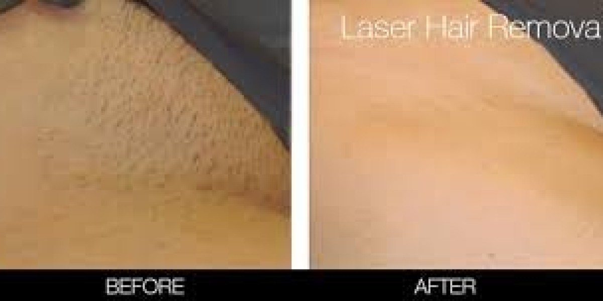 Choosing Your Laser Hair Removal: Basic Brazilian vs. Full Brazilian