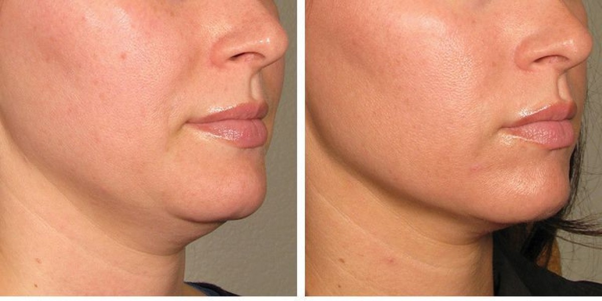 The Benefits of Laser Skin Tightening for Your Face