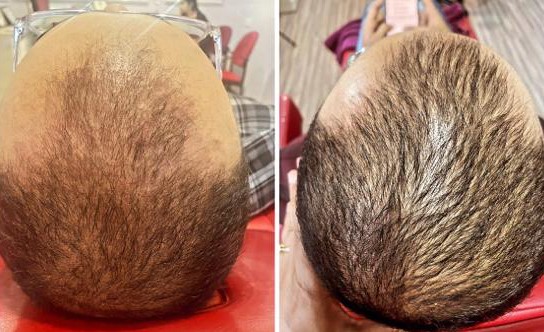 Best GFC PRP Hair Treatment Cost In Bangalore