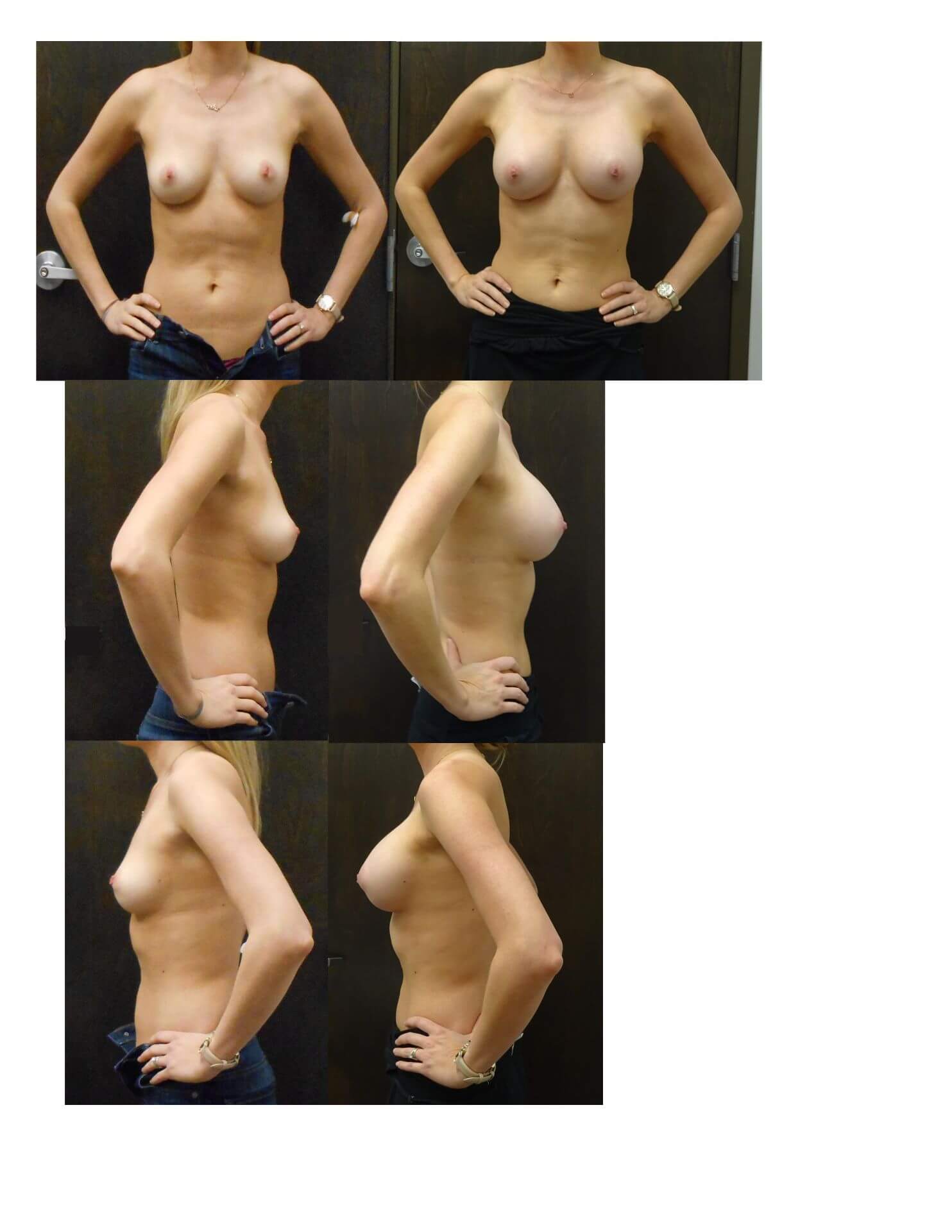 Breast Augmentation Surgery Metairie, Louisiana | Dr. Penelope Treece