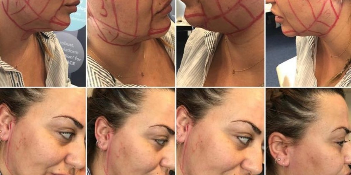 Non Surgical Face Lift Treatment