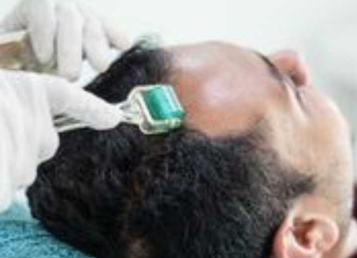 Mesotherapy/ Dermaroller - Hair Loss In Mumbai | The Skin Doctor
