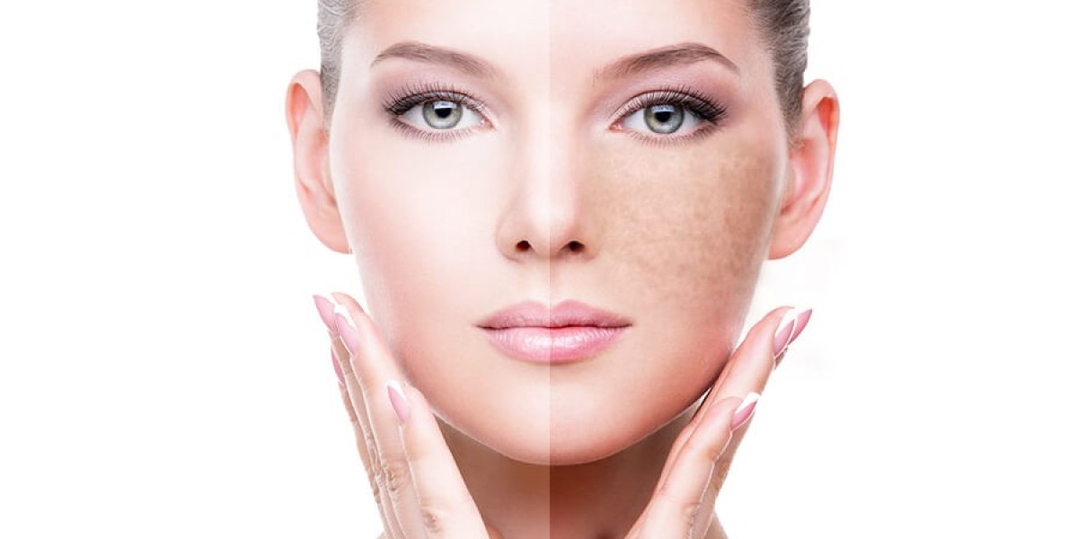 Pigmentation on Cheeks- How to Get it Treated With Lasers