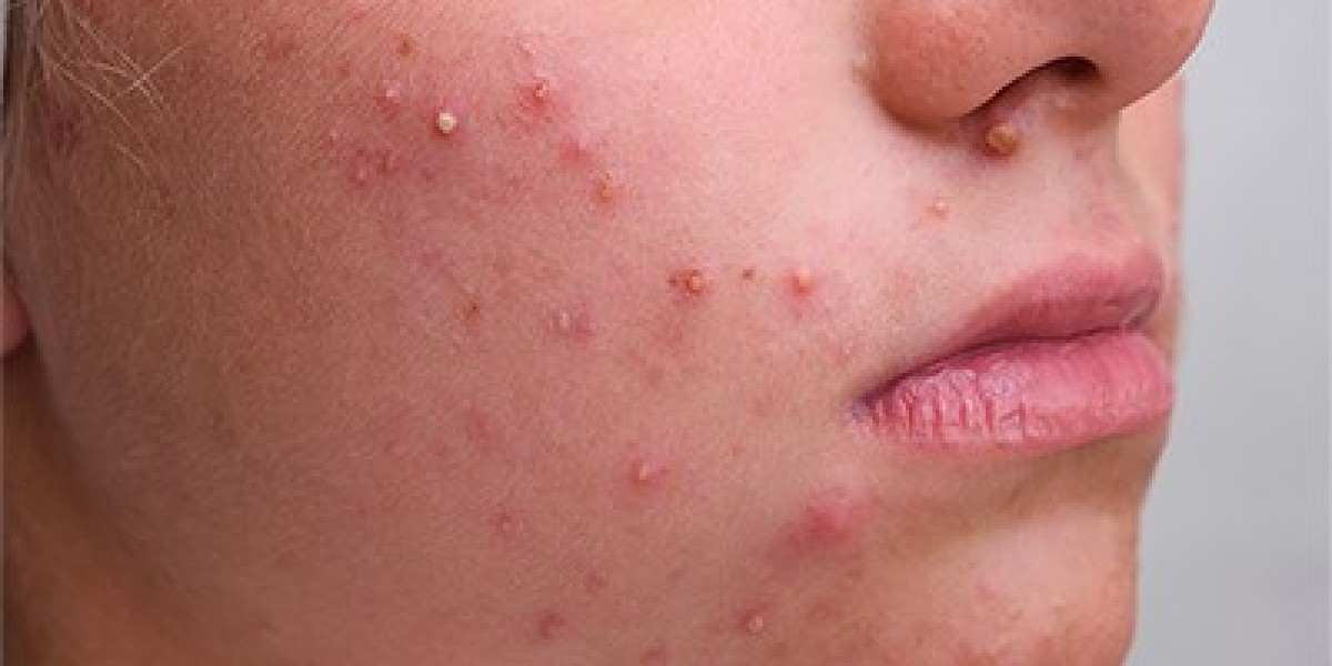 The Relationship Between Gut Health and Acne: Tips for a Healthy Gut