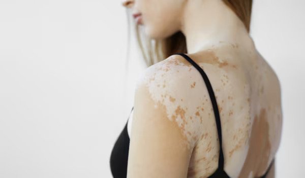 The Best Natural Remedies for Tinea Versicolor: Say Goodbye to Fungal Infections! - Natural Health News