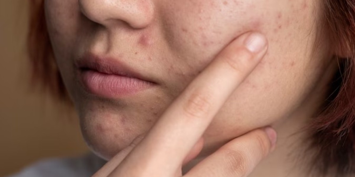 Preventing Acne Scars: Effective Tips for Managing Acne Breakouts the Skin