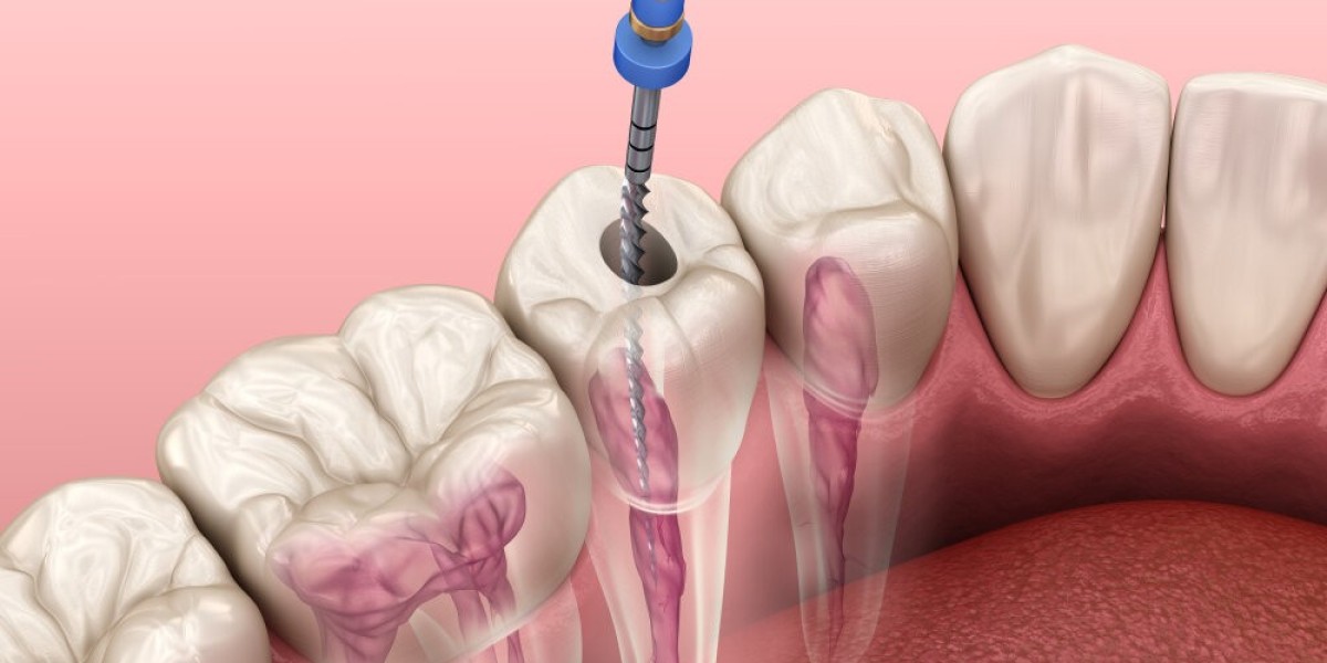 Where Can I Find Reliable Root Canal Treatment Near Me?