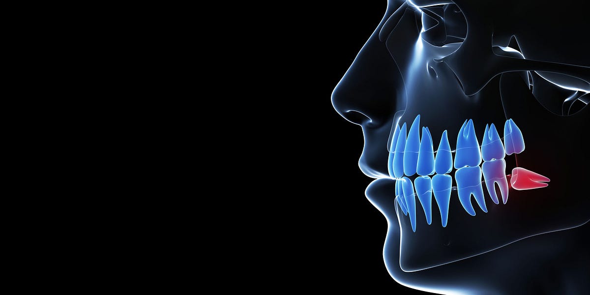 Understanding the Cost of Wisdom Tooth Extraction | by Smile Delhi - The Dental Clinic | Aug, 2023 | Medium