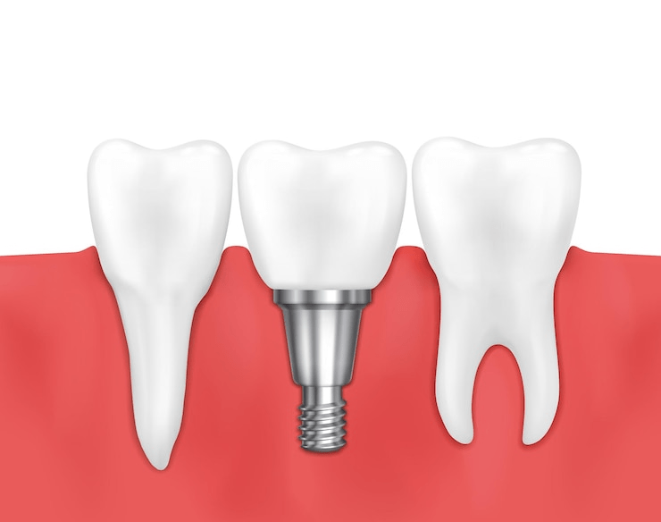 Dental Implants: What You Need to Know