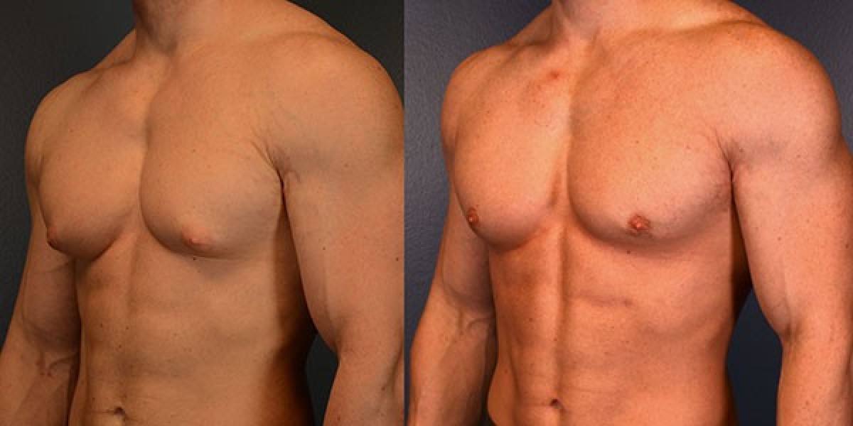 Gynecomastia Surgery: A Path to Confidence and Well-being