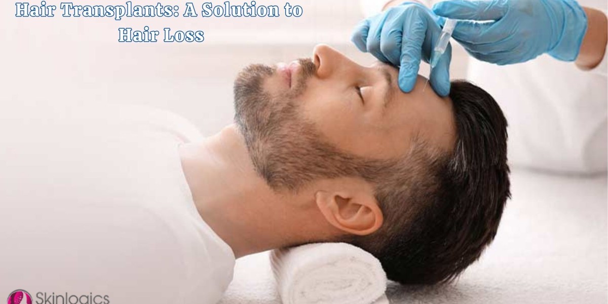 Hair Transplants: A Solution to Hair Loss
