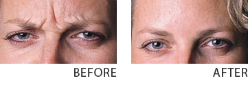 Anti-Wrinkle Injections Adelaide - Respect Cosmetic Medicine and Beauty – Adelaide Clinic