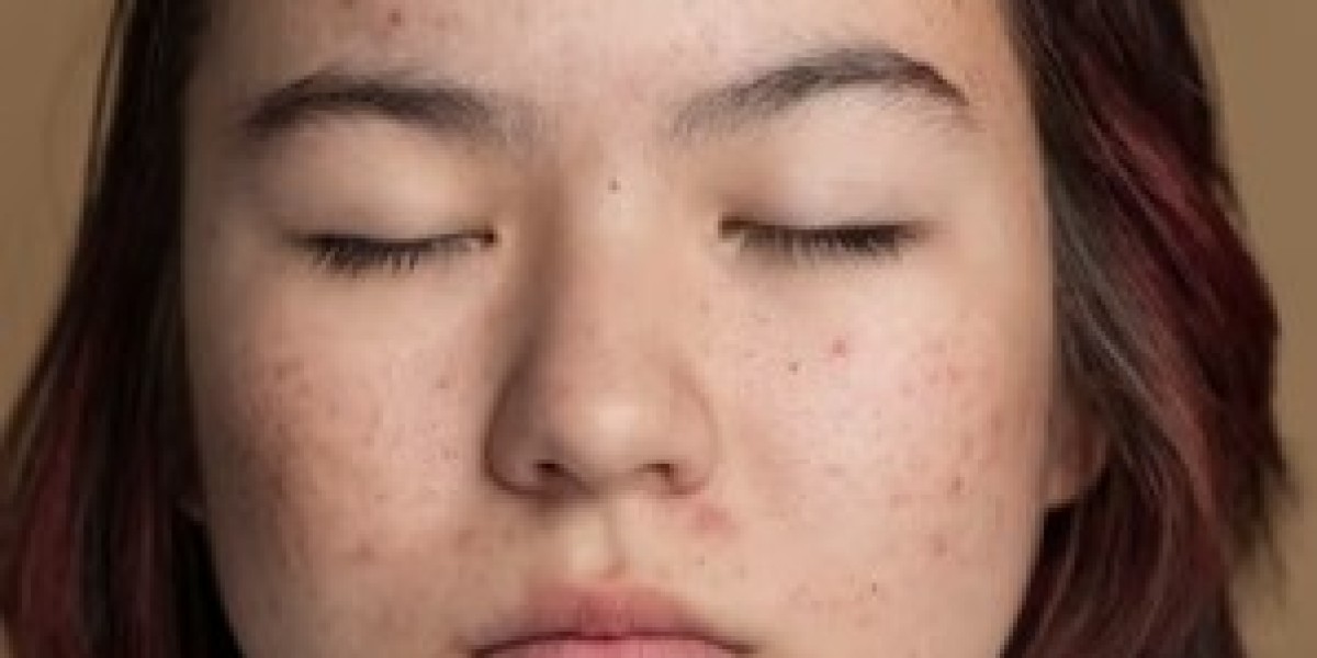The Science Behind Acne Scars: What Causes Them and How to Prevent Them