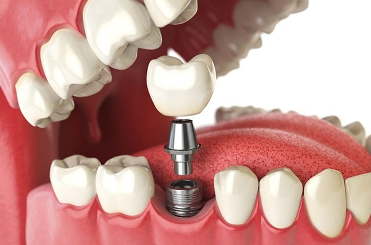 How to Prepare for the Dental Implant Procedure | by Dentistsofpreston | Oct, 2023 | Medium