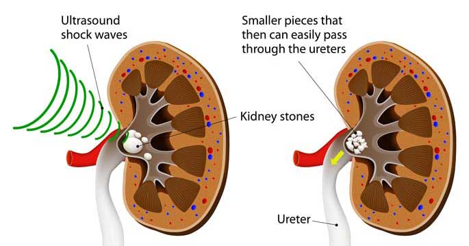 How long does it take to pass a kidney stone - sports-passion.net