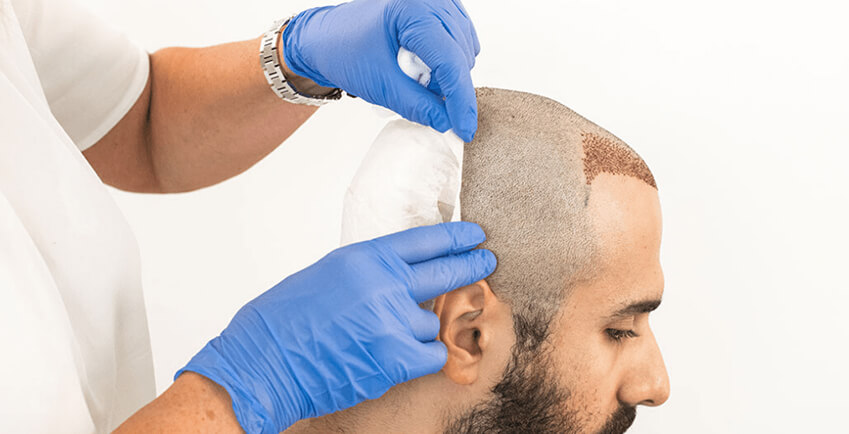 What Type Of Hair Transplant Is Best For Women? | TheAmberPost
