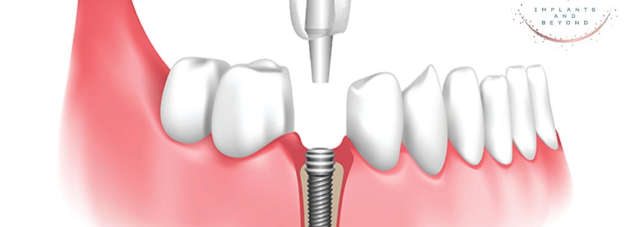 Allon4 and Allon6 Dental Implant Cover Image