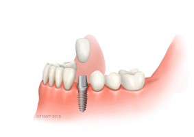 What to Expect During and After Successful Dental Implant Surgery - WriteUpCafe.com