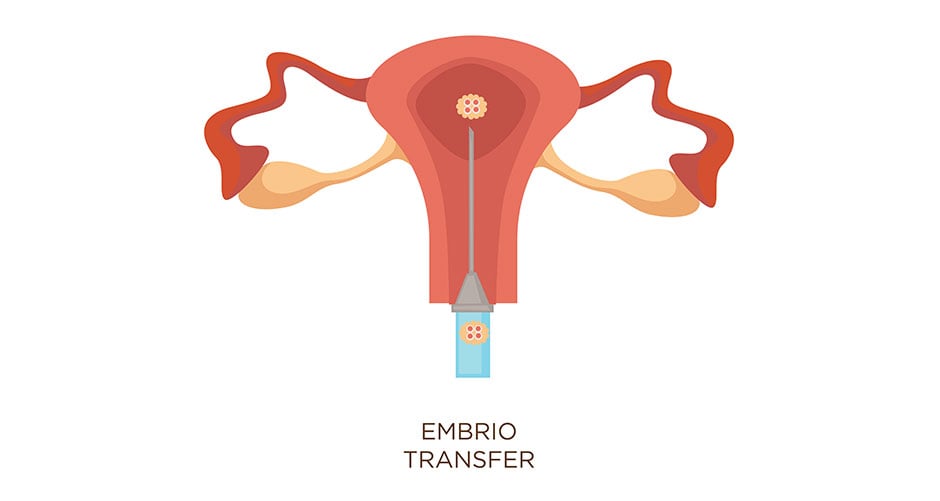 How Can I Make My Embryo Transfer Successful? | Zupyak