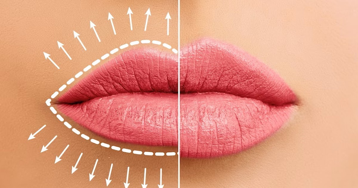 Most Common Causes That Fill Your Lips Damage You Weren’t Aware Of