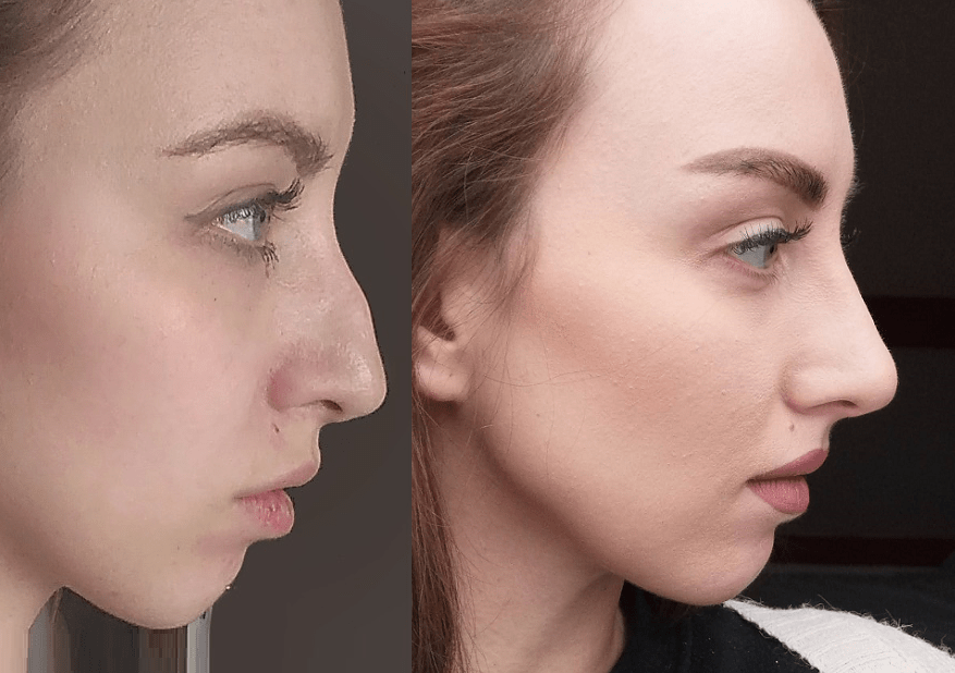 Nose Correction Isn’t About Aesthetics Only! Know The Medical