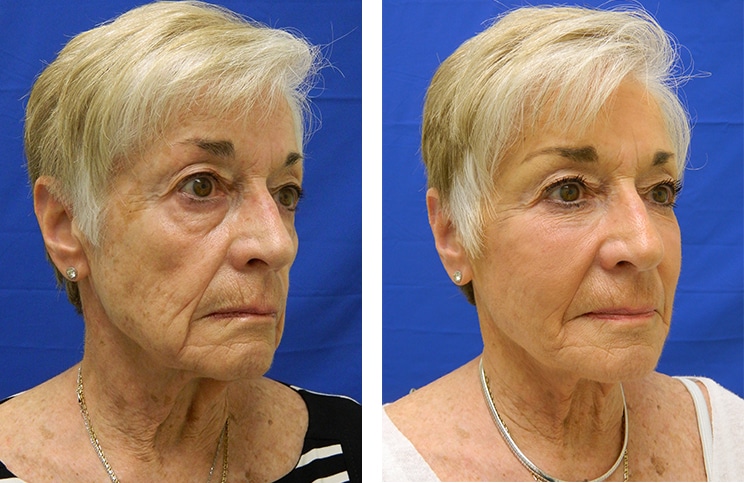 Is Liquid Face Lift Good At Early Age Or Should Be Only Done At