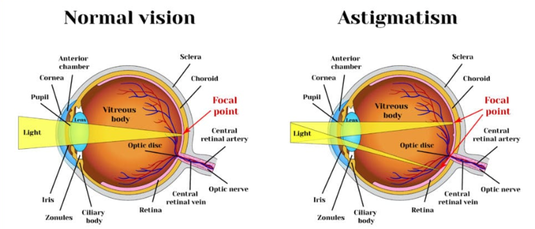 LASIK Surgery For Astigmatism Treatment - Blog