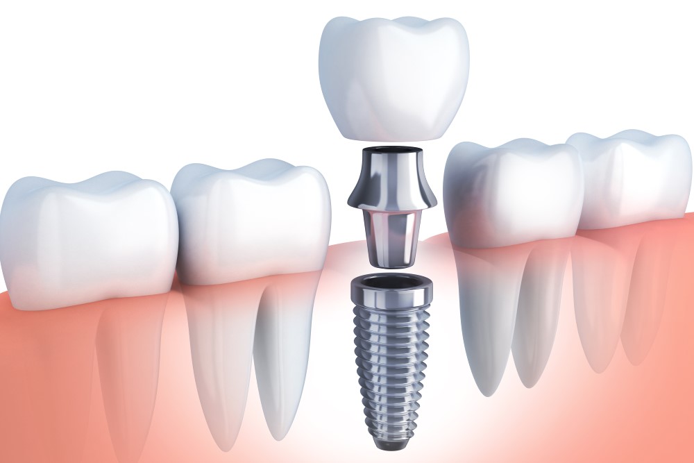 Dental Implants Aftercare Tips | TheAmberPost