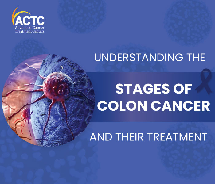 Understanding The 5 Stages Of Colon Cancer