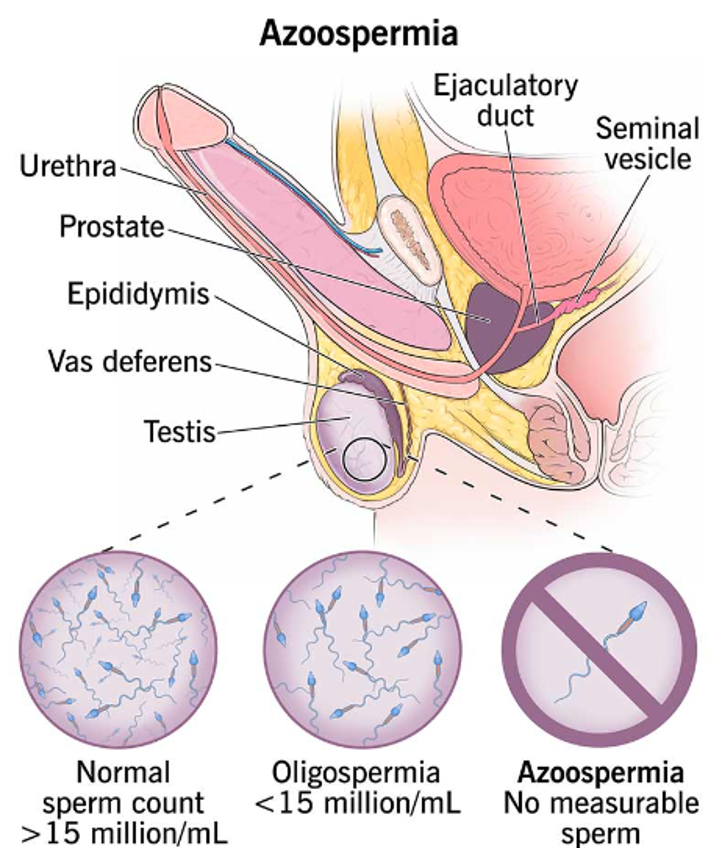Can Azoospermia be Treated?