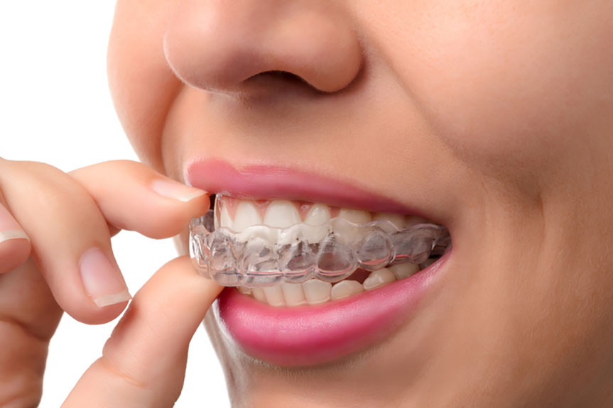 Don’t Hide your Smile – Straighten your Teeth with Invisalign - admin