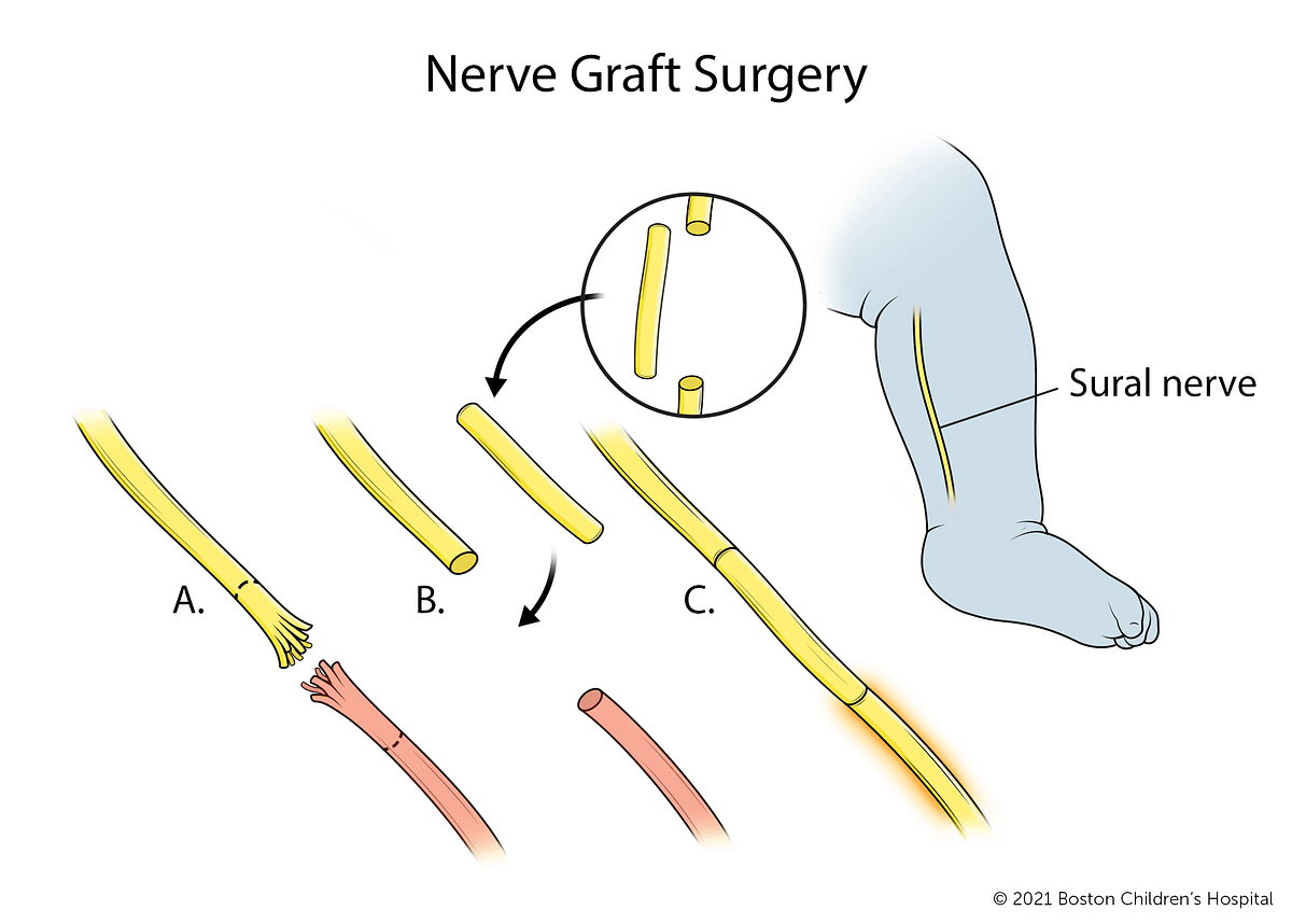 Beyond Birth Trauma: Seeking Justice for Babies Affected by Nerve Damage | by Erbspalsyinfony | Mar, 2024 | Medium