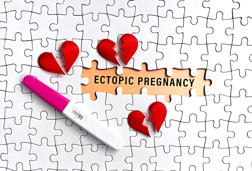 How to Avoid Ectopic Pregnancy with IVF?