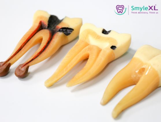 Root Canal Treatment In India | SmyleXL Dental Clinic